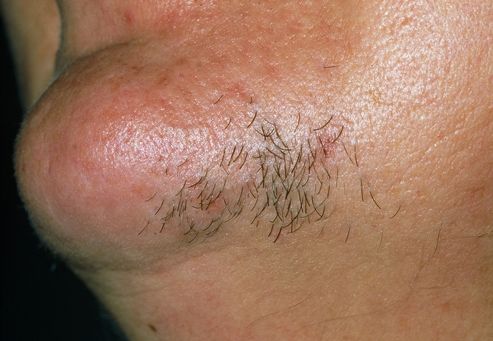 Hirsutism. Hirsutism (excessive hairiness) on the face of a 38 year old woman. Hirsutism is fairly common, especially in dark haired women after the menopause. It can occur before this as a result of conditions such as polycystic ovary syndrome, adrenal hyperplasia or anabolic steroid use. The hair can be removed by electrolysis, waxing or depilatory creams. The hair can also be bleached to reduce its visibility.