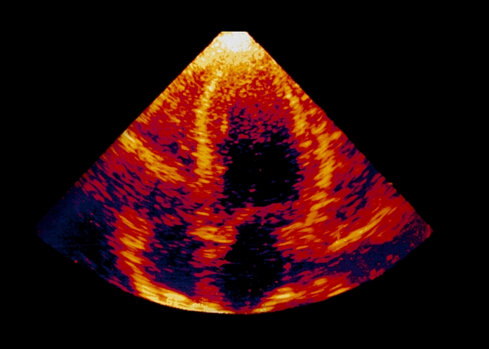 Enlarged heart. Coloured ultrasound image of the human heart showing left ventricular hypertrophy, (enlargement of the left ventricle). The heart is viewed upside down in this image, with the enlarged left ventricular chamber at upper right of image. Below this is the left atrium with the smaller right atrium of the heart at it's immediate left. Hypertrophy of the heart can be caused by high blood pressure, or failure of the mitral heart valve to control blood flow in the left ventricle. It can cause heart failure in severe cases. Ultrasound scanning uses echoes of high-frequency sound to produce images of structures within the body.