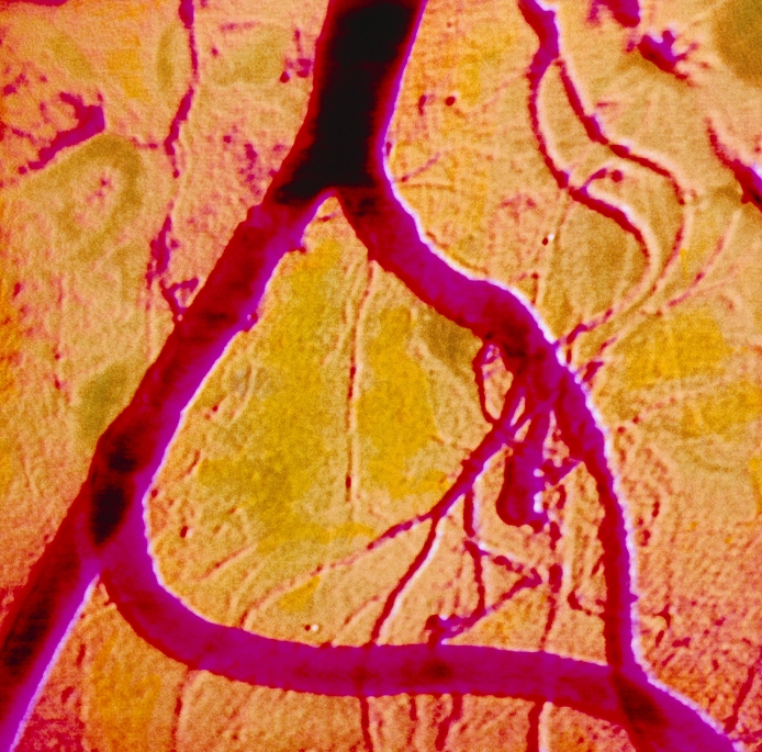 Iliac arterial bypass. Coloured angiogram of an arterial bypass (lower frame, S-shaped) between a patient's right and left iliac arteries. The bypass is made from a section of vein, artery or synthetic tubing and allows blood to flow past the severe narrowing in the iliac artery on the right. The large blood vessel at the top is the aorta. This divides in the lower abdomen into the two iliac arteries, which carry blood to the legs. Narrowing of major arteries in the legs is usually caused by atherosclerosis, where fatty deposits build up on the inside wall of an artery. In severe cases this can lead to chronic ulceration, numbness and gangrene in the affected limb.