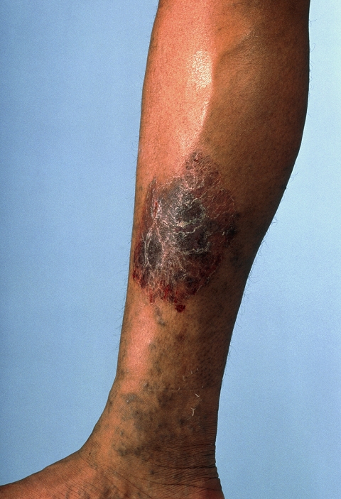 Venous insufficiency. Leg with discolouration and flaking skin due to chronic venous insufficiency, or inadequate blood flow through the leg veins. This form of peripheral vascular disease can have several causes: the narrowing of the blood vessels (stenosis); the formation of a blood clot in a vein, which is known as deep vein thrombosis, or, if the vein is also inflamed, thrombophlebitis. Lack of blood produces pain and aching after walking, and can lead to leg ulcers or even gangrene. Blood clots are normally treated with anti-inflammatory, anticoagulant and thrombolytic (clot-dissolving) drugs, although surgery may sometimes be necessary.