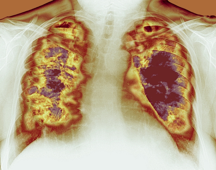 Lung cavities. Coloured chest X-ray showing large cavities (dark red) in the lungs of a patient in a case of Wegener's granulomatosis. This is a rare vascular disorder where blood vessel inflammation (vasculitis) causes the formation of granuloma (inflammatory lesions). These lesions can form in the lungs, kidneys and nasal passages. The lesions can either help in repairing the tissue or cause further damage, leading to widespread tissue death (necrosis). The large cavities seen here are due to necrosis of lung tissue. Treatment is with high doses of steroids initially, and low doses for one year. If diagnosed early, most patients recover.