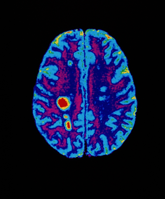 Multiple sclerosis. Coloured magnetic resonance image (MRI) scan of an axial section through the brain of a patient with multiple sclerosis (MS). The cerebral hemispheres are seen here. Grey matter is on the cerebral outer edges; white matter is found deeper in the brain. Lesions caused by MS are seen at left and lower left (red/yellow). They are due to destruction of myelin sheaths around nerve fibres. Progressive destruction of myelin in the brain and spinal cord produces such symptoms as unsteady gait, tremor, speech defects, paralysis and incontinence. MS is thought to be an autoimmune disorder.