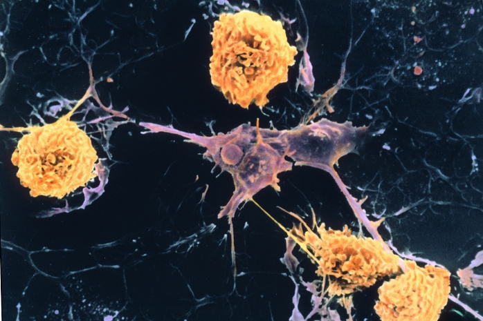 Multiple sclerosis. Coloured Scanning Electron Micrograph (SEM) of microglial cells (yellow) ingesting branched oligodendrocyte cells (purple). This is the process thought to occur in multiple sclerosis (MS). Oligodendrocytes form insulating myelin sheaths around nerve axons in the central nervous system. Microglia normally ingest cell debris and bacteria as part of the body's immune response. In MS they attack oligodendrocytes, possibly triggered by a virus in people with hereditary susceptibility. Destruction of myelin sheaths leads to loss of nerve function. Symptoms include unsteady gait, visual & speech defects and paralysis. Magnification: x875 at 5x7cm size.