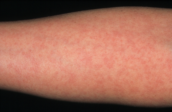 German measles. Arm of a 29-year-old woman showing rash due to German measles. German measles, or rubella, is a viral disease mostly affecting children. It causes mild symptoms including a light rash (seen here as small pink spots) that lasts several days. Infected adults may have more serious symptoms including fever and headache. The disease is most serious, however, if a woman is infected during the early months of pregnancy. If the virus is passed to the foetus the baby may be born with severe abnormalities such as deafness and heart disease. Rubella is prevented by vaccination, which is given to babies in the triple MMR (measles, mumps, rubella) vaccine.