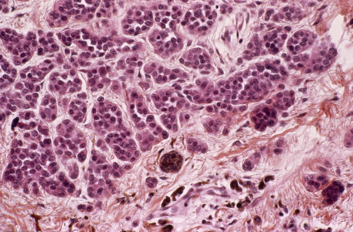 Skin mole. Light micrograph of a section through a compound naevus, a type of skin mole. This pigmented naevus is produced by abnormal clustering of pigment cells (melanocytes) in the skin. This section through the dermis contains clusters of melanocytes, which have many purple nuclei. Like other moles, naevi are harmless, but on rare occasions can become cancerous.