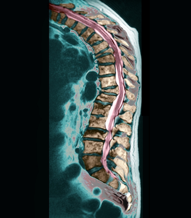 Osteoporosis. Coloured sagittal (side) magnetic resonance imaging (MRI) scan through the back of a 60-year-old patient with osteoporosis. The front of the body is at left. The spinal blocks of bone (vertebrae, brown) are seen enclosing the spinal cord (pink). Several vertebrae have collapsed due to the effects of osteoporosis. Good examples are just above centre and at upper centre. The effect of these collapses is a hunched spinal curvature (upper left). Osteoporosis is a decrease in bone density due to loss of bone material. It is mostly seen in the elderly and menopausal women. Surgical intervention can stabilise the spine. MRI scanning uses magnets and radio waves to image the body.