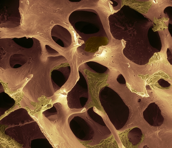Osteoporosis. Coloured scanning electron micrograph (SEM) of osteoporotic bone. Part of the surface of the bone (orange) has degraded, showing the underlying tissue (yellow). This is due to an imbalance in the activity of osteoclasts (cells that reabsorb bone tissue) and osteoblasts (cells that form new bone tissue). Osteoporosis (brittle bone disease) causes a loss of bone mass and an increase in the bone's porosity, making it more brittle and likely to fracture. It commonly affects post-menopausal women, who experience a decrease in levels of the hormone oestrogen. It may also develop after injury or infection. Treatment is with hormone replacement therapy (HRT) and drugs that slow the rate of bone loss. Magnification: x27 when printed 10cm wide.