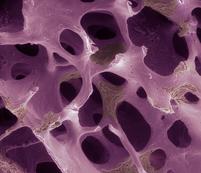 Osteoporosis. Coloured scanning electron micrograph (SEM) of osteoporotic bone. Part of the surface of the bone (pink) has degraded, showing the underlying tissue (brown). This is due to an imbalance in the activity of osteoclasts (cells that reabsorb bone tissue) and osteoblasts (cells that form new bone tissue). Osteoporosis (brittle bone disease) causes a loss of bone mass and an increase in the bone's porosity, making it more brittle and likely to fracture. It commonly affects post-menopausal women, who experience a decrease in levels of the hormone oestrogen. It may also develop after injury or infection. Treatment is with hormone replacement therapy (HRT) and drugs that slow the rate of bone loss. Magnification: x27 when printed 10cm wide.
