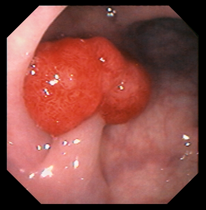Polyp. Endoscope view of a benign (non-cancerous) stalked polyp in a patient's colon (large intestine). This is an adenoma, a tumour arising from the epithelial tissue lining an organ. If the polyp causes discomfort, for instance by obstructing the flow of food along the intestine, it is removed surgically. Some types of polyp may turn cancerous, and are removed as soon as they are discovered.