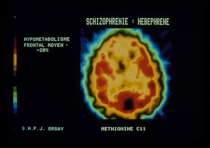 Tomography) scan of an axial section of the brain of a person suffering untreated schizophrenia. The use of the radioactive tracer 'methionine' (an amino acid) injected into the body, shows protein synthesis in the brain. The tracer appears red, with frontal lobes of the brain (at top) appearing deficient; more red areas of protein synthesis would be expected in this area in a normal brain. In schizophrenia, changes in mood are typical. The neurotransmitter 'serotonin' is one chemical made in the frontal lobes of the brain which controls moods. Low protein synthesis & abnormal serotonin levels may be associated with schizophrenia.