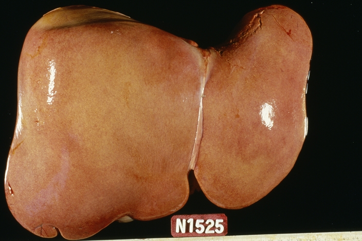 fatty liver Liver steatosis. Gross specimen of a liver affected by steatosis or fatty degeneration. This is a form of tissue damage in which globules of fat are deposited in cells. It can be caused by viral infection of the liver  hepatitis .