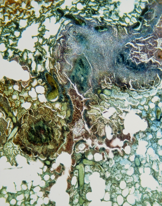 Light micrograph showing lesions in the lung of a patient suffering from miliary tuberculosis. The blue area (upper right) and the dark green circular area (left) are regions of caseous necrosis; the white areas are alveoli (tiny air sacs) Miliary tuberculosis is an acute, generalised form of tuberculosis. It occurs when an established tubercle erodes a blood vessel wall and tubercle bacilli are discharged into the circulation, spreading the disease to other parts of the lungs and to other organs, notably the liver, kidney & spleen. In this way vast numbers of new tubercles may be produced throughout the body. Magnification: x20 at 6x7cm size.