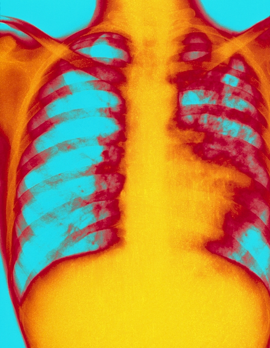 Tuberculosis. Coloured X-ray of a human chest with pulmonary tuberculosis in the patient's left lung (fluffy purple areas). The disease is caused by the bacterium Mycobacterium tuberculosis. When inhaled into the lungs, the bacteria form a primary tubercle (nodular lesion). They then spread to the lymph nodes. This form is called pulmonary tuberculosis or consumption & phthisis (wasting). Many people are infected without showing symptoms. Despite the immune system's ability to hold the disease in check, these people remain carriers, transmitting the bacilli by coughing or sneezing. Symptoms include fever, weight loss, night sweats & spitting of blood.