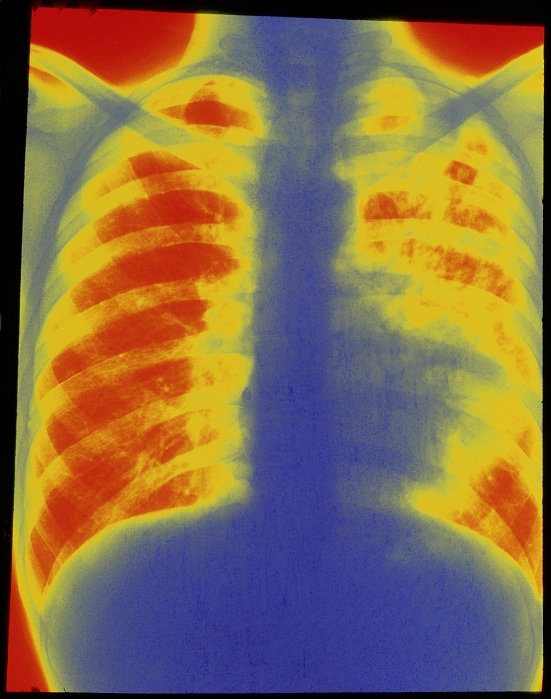 Tuberculosis. Coloured X-ray of a human chest with pulmonary tuberculosis in the patient's left lung (fluffy yellow areas). The disease is caused by the bacterium Mycobacterium tuberculosis. When inhaled into the lungs, the bacteria form a primary tubercle (nodular lesion). They then spread to the lymph nodes. This form is called pulmonary tuberculosis or consumption & phthisis (wasting). Many people are infected without showing symptoms. Despite the immune system's ability to hold the disease in check, these people remain carriers, transmitting the bacilli by coughing or sneezing. Symptoms include fever, weight loss, night sweats & spitting of blood.