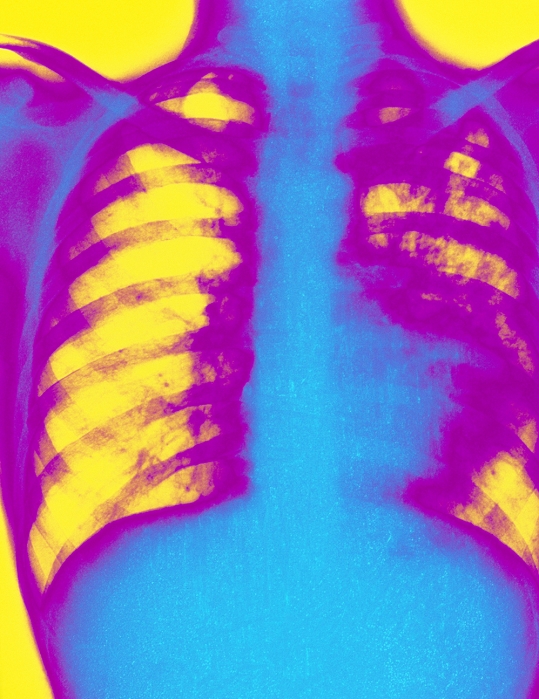 Tuberculosis. Coloured X-ray of a human chest with pulmonary tuberculosis in the patient's left lung (fluffy purple areas). The disease is caused by the bacterium Mycobacterium tuberculosis. When inhaled into the lungs, the bacteria form a primary tubercle (nodular lesion). They then spread to the lymph nodes. This form is called pulmonary tuberculosis or consumption & phthisis (wasting). Many people are infected without showing symptoms. Despite the immune system's ability to hold the disease in check, these people remain carriers, transmitting the bacilli by coughing or sneezing. Symptoms include fever, weight loss, night sweats & spitting of blood.