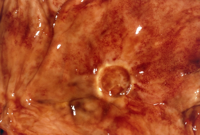 Clinical photograph of a stomach (gastric) ulcer, taken after a partial gastrectomy, the surgical removal of part of the stomach. The ulcer is almost perfectly circular, with a yellow border. Symptoms include vomiting and upper abdominal pain after eating. Causes are related to diet, alcohol consumption, stress and aspirin- like drugs (the NSAID group). Complications such as bleeding, perforation and obstruction due to scarring may occur. The symptoms are alleviated by antacid medicines, and by drugs that reduce the production of gastric acid. Severe cases may require surgery. Gastric & duodenal ulcers are commonly called peptic ulcers.