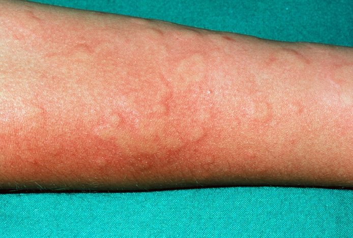Urticaria - skin rash on arm. View of inflammation & raised wheals on an arm. This is caused by an allergic reaction (in this case the allergen is unknown) and is called urticaria. Urticaria is a transient condition characterised by itchy swell- ings and flushing of the skin. The rash is most commonly found on the limbs and trunk, but may appear anywhere on the body. Urticaria often results from an allergic reaction to food, for example strawberries, shellfish, milk or eggs; or to a drug such as penicillin or aspirin. Urticaria is treated by applying a soothing lotion to the skin, and by using anti-histamines or corticoster- oid (anti-inflammatory) drugs.