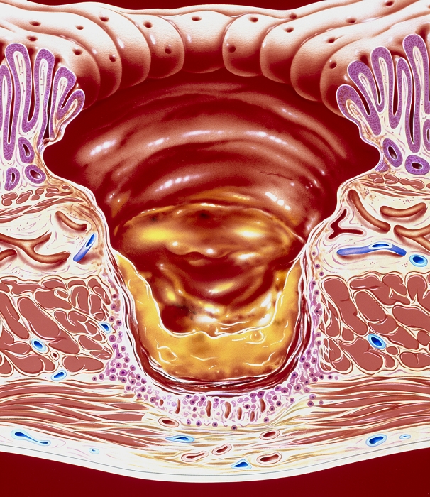 Stomach ulcer. Artwork showing a chronic gastric ulcer in cross section. Here, stomach acid, pepsin and bile have eroded the mucosa (stomach lining), the sub-mucosa and the muscular layers of the stomach wall. The red crater of the ulcer contains necrotic tissue & inflammatory cells (yellow). At the ulcer's base is a vascular layer & a layer of granulation tissue (first stages of tissue repair, pink). Deeper still is fibrous scar tissue. Causes of gastric ulcers are related to diet, stress, some drugs and certain bacteria. Bleeding, perforation and obstruction due to scarring may occur as complications. Symptoms are alleviated by antacid medicines; severe cases may need surgery.