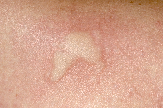 Hives. Weals on the skin of a 32 year old woman caused by urticaria. Urticaria, also known as hives and nettle rash, leads to itchy raised red rashes (weals) on the skin. The weals are caused by the release of chemicals into the tissues, which make small blood vessels leak fluid into the skin. Each weal may last for a few minutes or several hours. Urticaria is most often caused by a non-allergic reaction to foods or drugs, although it may also be caused by heat, cold, chemicals, stress and allergies among many other things. The cause of this case is unknown. Treatment is with antihistamines and avoidance of the cause, if known.