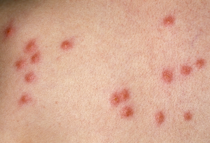 Flea bite marks on the skin of a 5-year-old girl. These marks (papules) occur due to a sensitivity (allergic) reaction to the bites, known as papular urticaria. Common sources of fleas include cats, dogs, birds, rabbits and hedgehogs. The human flea is now relatively uncommon due to improved sanitation. Symptoms from the bites may also include extreme itching (pruritis), breathing difficulties and dizziness. Fleas can cause illness through the spread of diseases such as plague or via secondary infection of the flea bite. Flea bites can be treated with a steroid cream and a topical antipruritic, although the source of the fleas needs to be investigated.
