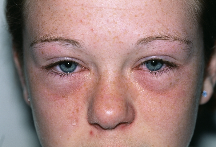 . Hay fever. Eyes of a 15-year-old girl suffering from periorbital oedema and allergic conjunctivitis as a result of hay fever. Hay fever is a very common allergic response to airborne particles, such as pollen. When allergens come into contact with the eyes, they can provoke this exaggerated response from the immune system. Periorbital oedema is the collection of fluid around the eye sockets, giving the eyes a swollen and puffy appearance. Allergic conjunctivitis is the inflammation of the conjunctiva, the clear membrane covering the eye. It causes the eyes to become red, watery and sore. Treatment for hay fever is with anti-histamines. MODEL RELEASED