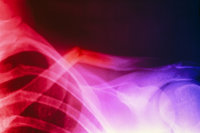 Fracture of the clavicle. Coloured X-ray image showing a fractured clavicle (centre left), also known as collarbone, the bone that articulates the sternum and the scapula (shoulder blade). It is treated by immobilising the shoulder and arm with a clavicle strap or a figure-of-eight wrap between the shoulders and over the back. Healing usually takes three weeks to complete.