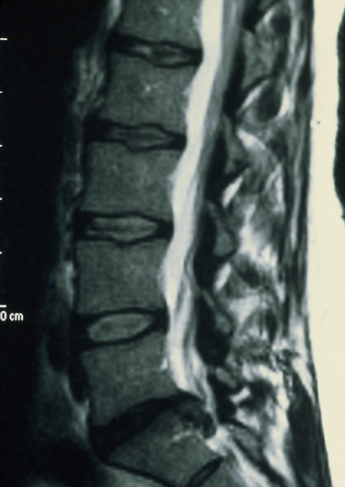 Disc prolapse. Magnetic resonance imaging (MRI) scan of a sagittal slice through the lower spine of a 37-year-old woman showing a prolapsed disc. A prolapsed or 'slipped' disc is a common spine disorder caused by disc degeneration with age or a sudden injury. Here, 4 healthy discs (oval) between the 5 lumbar vertebrae (grey, squares) can be seen. Below them, at bottom centre, the disc between the 5th lumbar vertebra and the first fused vertebra of the sacrum has prolapsed (black, flattened). Its pulpy interior is protruding into the spinal cord (thin, white). This will cause pain and may be disabling. Treatment is usually bed rest though surgery is sometimes needed.