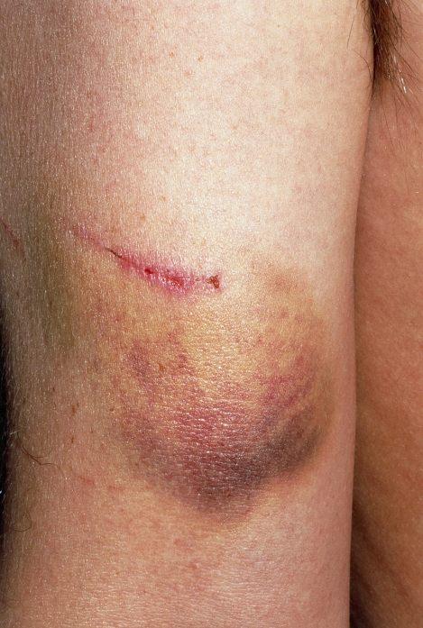 Scratch and bruise (image 5 of 7). Close-up of a scratch and bruise on a man's arm, five days after the injury occurred. The skin damaged by the scratch (at centre) has now healed leaving a slight scar. However, at the left of the scratch is a fresh scab (dark red) of clotted blood, due to reopening of the wound in that area. The bruise below the scratch has now fully developed. Break- age of the tiny blood vessels (capillaries) in the skin has caused much purple discoloration. Areas of yellow are due to the breakdown of haemoglobin (the blood's pigment). (See photo numbers M330/668-671 & M330/673-674 for the scratch & bruise on days 1-4 & through to day 7).
