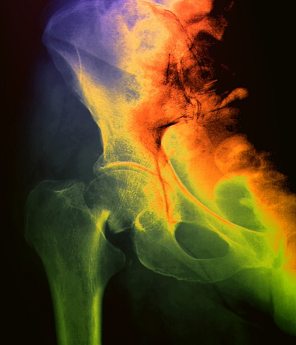 Broken hip. Coloured X-ray of the right hip of a patient, showing a fracture of the neck of the upper leg bone (femur). The femoral head (round, centre left) has separated from the femoral shaft (lower left) due to this fracture. The rest of the image comprises the right half of the pelvis. The femoral head, in its pelvic cap, forms the ball- and-socket hip joint. Severe hip fractures may require hip replacement or pinning of the bones.