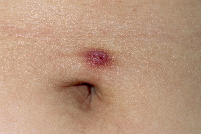 Infected wound by the belly button (navel) of an 18 year old woman. This was caused due to improper care of a piercing site. Topical antibiotics may be used to destroy the infecting bacteria.
