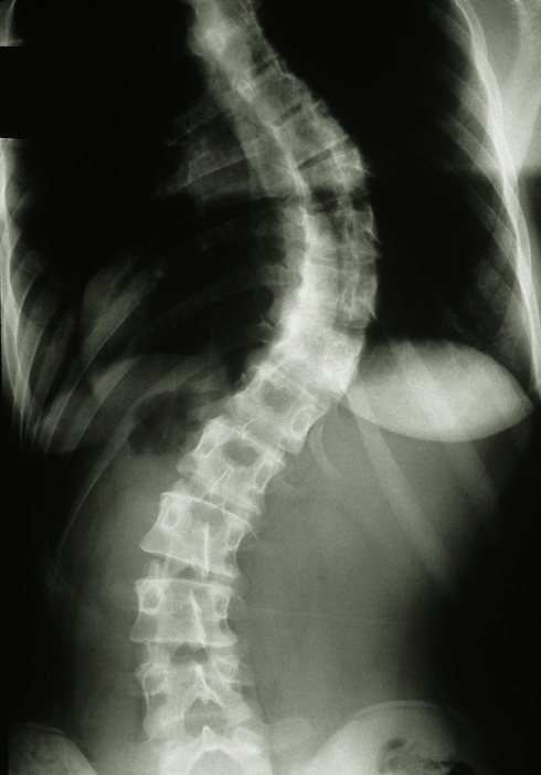 Scoliosis of the spine. X-ray showing lateral (sideways) curvature of the human spine, known as scoliosis. Here, curvature is seen among the thoracic vertebrae (above centre) in the region of the ribcage. The pelvis is at bottom. Scoliosis typically begins in childhood, progressing to an S-shaped spine until the age when growth stops. The condition may result from congenital abnormal- ity of the spine; from polio; arthritis; or due to one leg being shorter than the other. Slight scoliosis of unknown cause may not require treat- ment. Progressive scoliosis may need spinal immobilization with a brace or surgery.