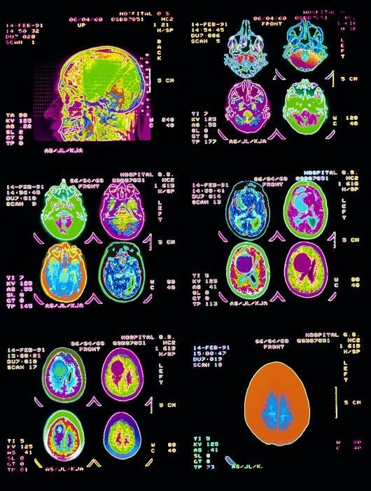 CT brain scans. Assortment of coloured computed tomography (CT) scans of the human brain. At top left is the head sectioned in sagittal view; all other scans show the brain in horizontal (axial) section. A rounded brain tumour is revealed (magenta) in some of the brain scans at centre right. CT scanning creates 'slice' images through the body using X-rays. It is useful in detecting brain tumours and cancer.