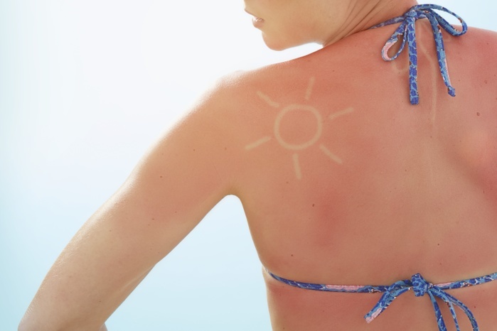 Woman with sunburnt back MODEL RELEASED. Woman with sunburnt back and sun shape on shoulder.