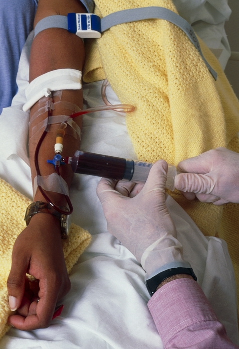 Sickle cell blood transfusion. Pregnant female patient with sickle cell anaemia undergoing a blood transfusion. Gloved hands are injecting the blood from a syringe through a cannula into a vein in her arm. Sickle cell anaemia is an inherited blood disease occurring primarily in black people. It is caused by abnormal haemoglobin in oxygen- carrying red blood cells, which makes the cells sickle-shaped. Blood transfusions may be performed to temporarily replace these deformed red blood cells. This may be done regularly for people who suffer frequent and severe sickle cell crises. It is also vital during pregnancy, when red blood cells supply oxygen to the growing foetus as well.