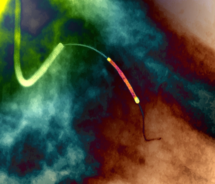Coronary angioplasty. Coloured X-ray angiogram of a balloon catheter and stent (brown, upper centre) being placed within a coronary artery of a heart. They will be used to treat stenosis (narrowing) of the artery. The flexible catheter used to place them there is seen snaking down from top left. The inflation of the balloon catheter will expand the artery and restore normal blood flow. The stent is a hollow tube mesh, expanded by the balloon catheter, that stays in the artery and supports it after the balloon catheter has been withdrawn. Arterial stenosis may arise from arterial disease. X-ray angiography injects a radio-opaque contrast medium to highlight blood vessels on X-rays.