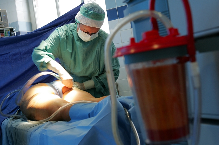 Liposuction. Image 10 of 11. Surgeon using a cannula (tube) to remove fat from a patient's buttock during a liposuction operation. This cosmetic surgery procedure removes unwanted fat from areas such as the hips, upper thighs and buttocks. The cannula is inserted through a small incision in the skin, and is used to break up fatty deposits. The residue is then sucked out down a plastic tube by a powerful vacuum into a storage container (right). For a sequence showing a liposuction procedure, see images M590/260 to M590/270.