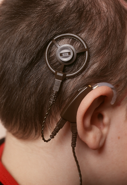 Cochlear implant fitted. External view of the side of the head of a ten year old girl, showing the transmitter (at top) and microphone (around ear) components of a cochlear implant (CI). Beneath the skin of the scalp is a receiver to which the transmitter is magnetically attached. From the implanted receiver run electrodes inserted deep in the cochlear of the inner ear, enabling impulses to reach the brain. The wire at lower frame leads to a sound processor box. CI surgery is performed on profoundly deaf patients unable to be helped by conventional hearing aids. A cochlear implant gives the patient an awareness of sounds and speech and assists the patient to lip-read.
