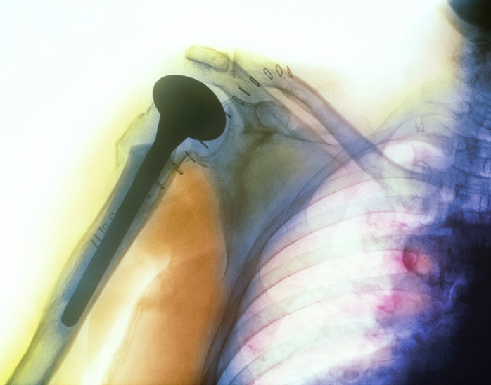 Shoulder prosthesis. Coloured X-ray of a prosthetic (artificial) shoulder joint (black, upper left) replacing the end of a bone fractured due to osteoporosis (brittle bone disease). The prosthesis has been cemented into the shaft of the fractured humerus (upper-arm bone, centre left). The shoulder joint is where the humerus meets the scapula (shoulder blade). The clavicle (collarbone) runs from upper centre to far right and the ribs are at lower right. Metal staples (small black loops) have been used to hold together the incision made to insert the implant. Osteoporosis is characterised by weaker bones that are more liable to fracture.