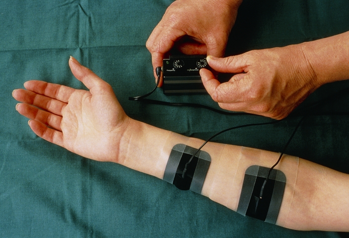 Person undergoing Transcutaneous Electrical Nerve Stimulation (TENS) in a hospital physiotherapy department, during assesment of pain control following damage to the radial nerve sustained in a road accident. Series of high-voltage, high- frequency electrical impulses are passed between the 2 electrodes on the forearm: the physiotherapist is seen adjusting their frequency & amplitude on the power supply unit. The technique has many applications in analgesia, being cheaper & safer than using drugs: it is not recommended for use on children or pregnant women. After an assesment period (up to 5 days), the patient may be able to continue treatment at home.
