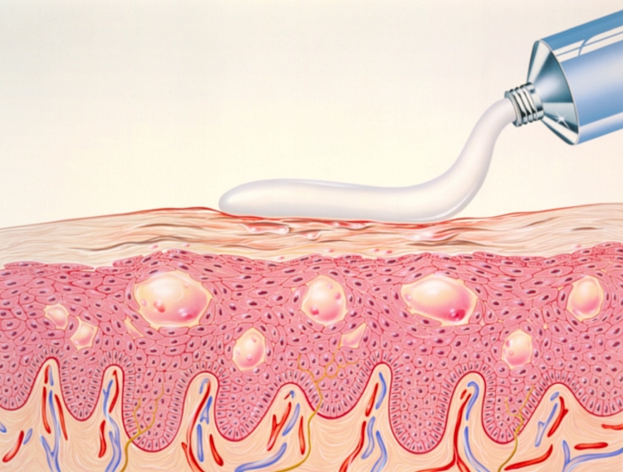 Treating eczema. Artwork showing the topical application of a cream to skin affected by eczema. Eczema is a condition in which the skin becomes inflamed, red and itchy, and fluid-filled vesicles (pale pink areas) form beneath the epidermis. These may rupture and join up forming a weeping area which may become infected. The use of corticosteroids such as hydrocortisone in topical applications greatly reduces the inflammation and irritation of eczema. Cortico- steroids suppress the inflammatory response by limiting the ability of white blood cells and tissue macrophages to produce substances, such as histamine, which mediate inflammation.