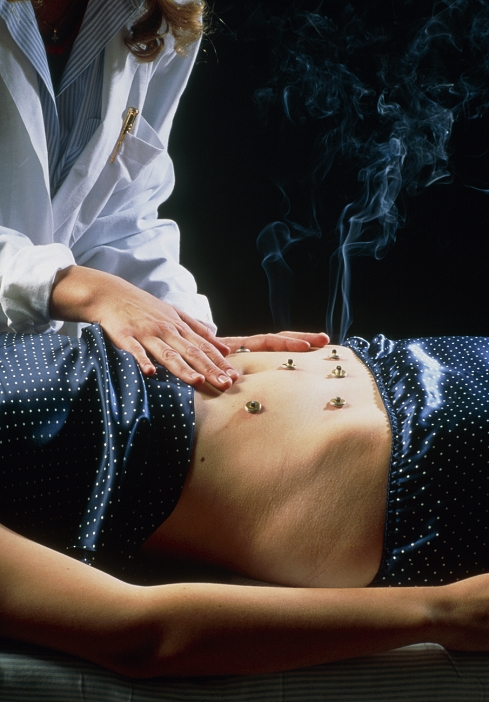 Moxibustion. Female acupuncturist examining burning moxa wool on acupuncture points on a female patient's abdomen. Moxa wool is made from dried mugwort leaves (Artemisia vulgaris). Sticks of moxa can also be used to heat the skin directly at acupuncture points. Moxibustion is used to warm the body's Qi (life force), mainly in the treatment of conditions characterized by coldness and dampness. Acupuncture was developed in China on the theory that Qi flows along the body's meridian lines. It is believed that diseases are due to a blockage of this flow. Warming the points along the meridians is thought to restore normal flow.