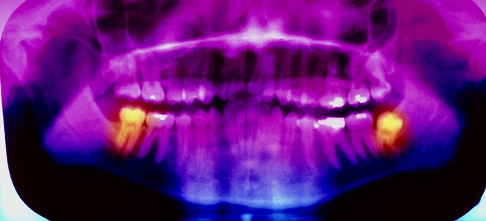 Erupted wisdom tooth. Coloured pan-oral X-ray of the mouth of a young adult, showing an erupted wisdom tooth. The wisdom tooth, highlighted in orange, is seen in the lower jaw (at right). It is growing slightly skew. At left in the lower jaw is a molar tooth (orange), beside which a wisdom tooth on this side of the mouth has not yet erupted. Adults usually have four wisdom teeth (known as third molars), one each in the rearmost region of the upper and lower jaws. In some people, however, not all wisdom teeth emerge. Typically they erupt between the ages of 17 and 21. A pan-oral X-ray provides a view of all the teeth in the mouth.