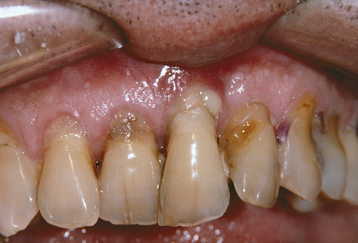 Periodontal disease. Mouth of a patient suffering from periodontal disease, showing receding gums and a periodontal abscess (white, centre). This disease is caused by chemicals released by the bacteria in plaque, a substance which covers the surface of unclean teeth. It results in the erosion of the tissues that attach the teeth to the jaw. In its advanced form spaces develop between the gums and the teeth and abscesses (pus- filled, inflamed areas) may form. Poor dental hygiene is the main cause of periodontal disease.