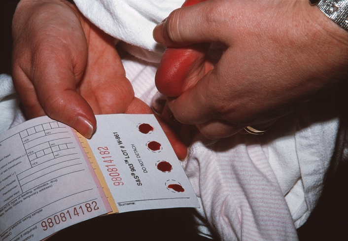 Guthrie blood test. Hands taking a blood sample from the heel of a newborn baby girl for a Guthrie test. This screens for a rare genetic disease, phenylketonuria (PKU), which affects around 1 in 16,000 people. PKU causes the amino acid phenylalanine to accumulate in the blood, which can cause severe brain damage. The baby's blood is smeared onto absorbent filter paper and cultured with bacteria whose growth is promoted by the presence of phenylalanine. The level of bacterial growth on the paper indicates the level of phenylalanine in the baby's blood. PKU babies are fed a phenylalanine-free milk substitute and a low-protein diet after weaning.