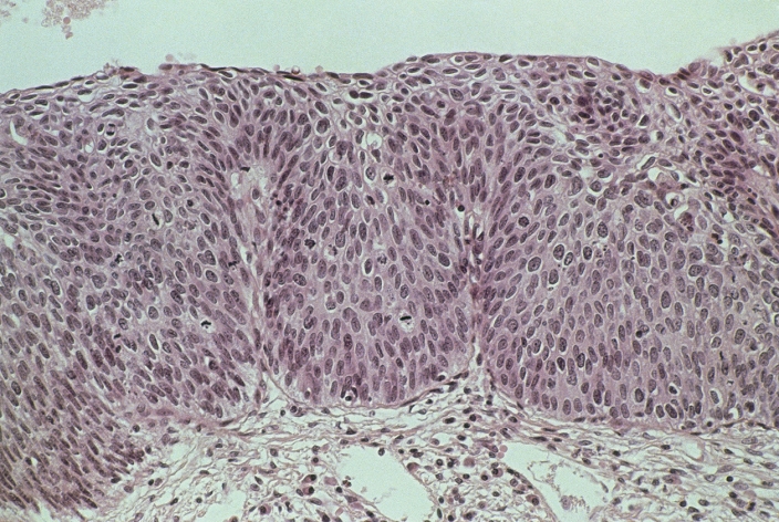Cervical cancer. Light micrograph of a section through a carcinoma in situ in the epithelium of a woman's cervix. In a normal cervix, cell division in the epithelium is confined to the basement mem- brane, with cells above becoming flat towards the top. In this cervix the upper layer is full of ac- tively dividing cancer cells with oversized, dark- staining nuclei. Mitosis (nuclear division) is seen in some cells, their nuclei appearing black. This tumour is classed as cervical intraepithelial neoplasia grade III, as the cells have not invaded the tissue below. Such tumours are destroyed by excision or laser burning. Stained with eosin and hematoxylin. Magnification x125 at 35mm size.