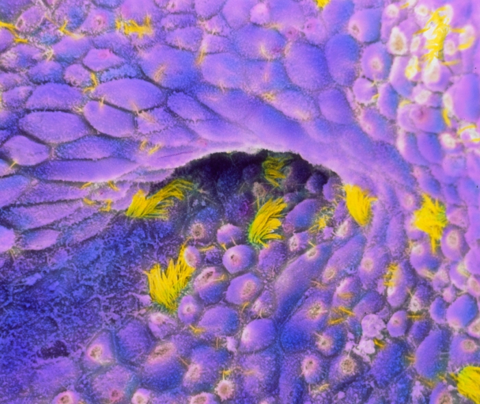 Cancer cells of ovary. Coloured Scanning Electron Micrograph (SEM) of carcinoma cancer cells of the human ovary. Known as 'endometrioid carcinoma' because these cells resemble carcinoma of the uterus. Two types of cells are seen: some ciliated cells with tufts of cilia (yellow); abundant secretory cells with microvilli (purple). A mucus secretion (white) is visible. These cells are cuboidal and/or columnar in shape, with irregular and proliferative growth. Carcinomas grow on the epithelial surface of body organs. It is a common ovarian cancer which can spread and may be fatal. Magnification: x500 at 6x7cm size.