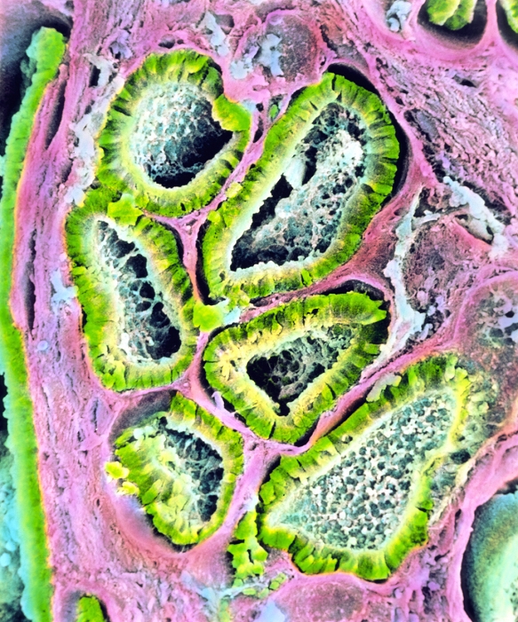 Sertoli-Leydig tumour in ovary. Coloured Scanning Electron Micrograph (SEM) of a section through a Sertoli-Leydig tumour in the human ovary. Known also as an 'arrhenoblastoma' or 'androblastoma', up to 30% of these tumours are malignant (cancer- ous). This well differentiated tumour is made up of tubules or branching cords (green) lined with cuboidal or columnar Sertoli cells. Between the tubules is an interstitial component made up of Leydig cells (light blue); the stroma of the ovary is pink. A Sertoli-Leydig tumour can produce hormones, and may cause masculinization in women. Magnification: x350 at 6x7cm size. x460 at 4x5'