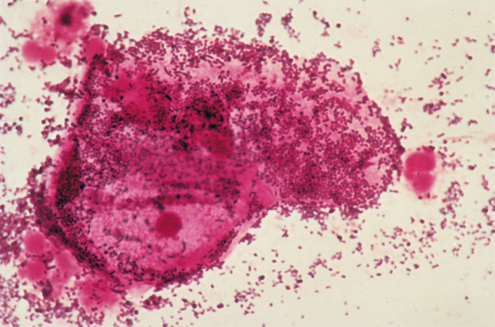 Bacterial vaginosis. Light micrograph of a cervical smear from a patient with bacterial vaginosis. An epithelial cell (pink, centre) is covered in Gardnerella vaginalis bacteria (rods), one of the species of bacteria that cause vaginosis. Bacterial vaginosis causes an abnormal vaginal discharge with an unpleasant fishy smell. It is caused by an imbalance of the normal vaginal flora. Treatment is with antibiotics.