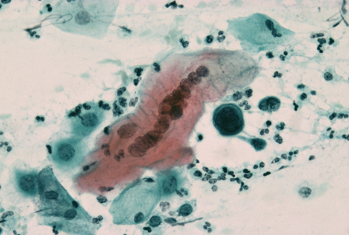 Herpes infection. Light micrograph of a cervical smear showing a cell (red) infected with the herpes simplex virus (HSV), cause of the sexually-transmitted disease (STD) herpes. The infected cell has multiple nuclei that have moulded together and become filled with viral particles. Genital herpes infections are most often due to HSV type 2, rather than HSV type 1. HSV type 2 has been implicated in the development of cervical cancer. Cervical smear tests are routinely performed to look for abnormalities in cells of the cervix, which might indicate the onset of cancer. Magnification: x1150 when printed 10cm wide.