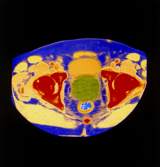 Prostate cancer. Coloured computed tomography (CT) scan of an axial section through the human pelvis, showing an enlarged prostate gland with cancer. At centre is the prostate (green) seen between bones of the pelvis (red). At lower centre, resting next to the prostate, is the rectum with its lumen (light blue). At upper centre is the bladder (yellow) which has been indented by the enlarged prostate. Prostate cancer typically affects elderly men, causing obstruction to the neck of the bladder & impairing urination. The cancer may spread to the bladder & other body regions. Treatment includes hormone drugs and surgery.
